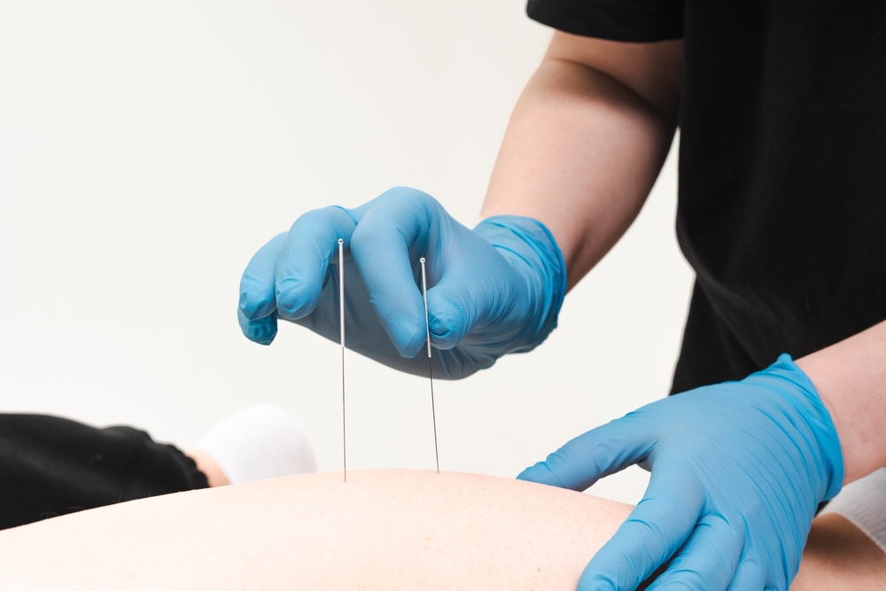 Dry Needling
